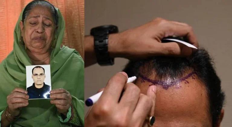 ഹെയര്‍ ഫിക്‌സിംഗ് ശസ്ത്രക്രിയയ്ക്ക് വിധേയനായ യുവാവിന് ദാരുണാന്ത്യം