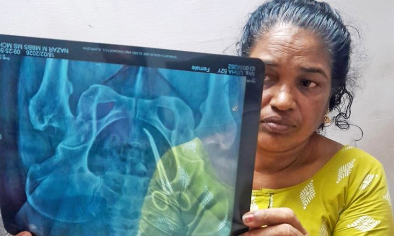 ഉഷ ജോസഫിന്റെ ശസ്ത്രക്രിയ പൂര്‍ത്തിയായി; വയറ്റില്‍ കുടുങ്ങിയിരുന്ന കത്രിക പുറത്തെടുത്തു