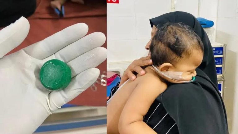 കുപ്പിയുടെ മൂടി തൊണ്ടയിൽ കുടുങ്ങി; പത്തുമാസം പ്രായമുള്ള കുരുന്നിന് മഞ്ചേരി മെഡിക്കൽ കോളേജിൽ ‘പുതുജീവൻ’